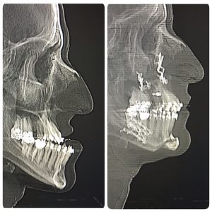 Avanco de maxila e recuo de mandibula - Ortognatica - Dr Felipe